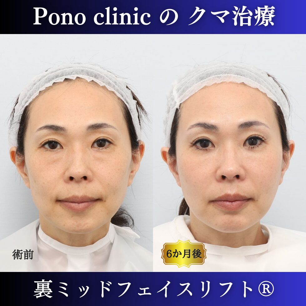 クマ取り東京、裏ミッドフェイスリフト、PRPF療法法令線、40代女性の症例