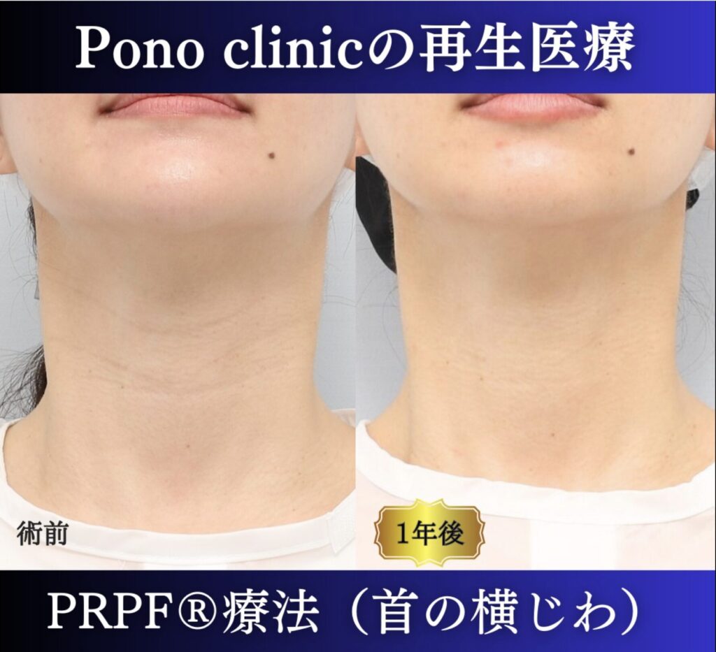 首の横しわ、30代の症例 (3)