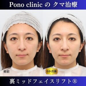 クマ取り東京、裏ミッドフェイスリフト、20代の症例