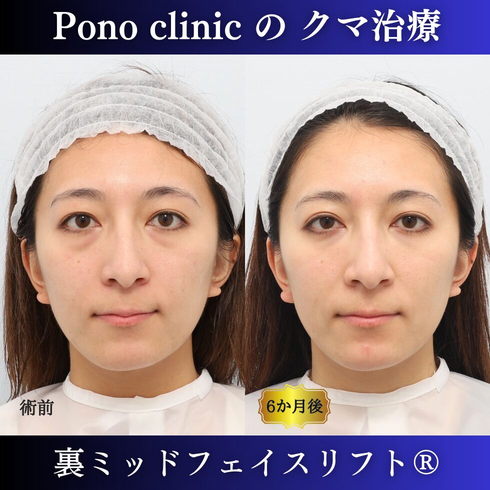 クマ取り東京、裏ミッドフェイスリフト、20代の症例