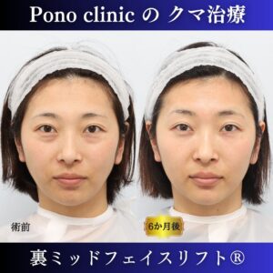 クマ取り東京、裏ミッドフェイスリフト、30代女性の症例