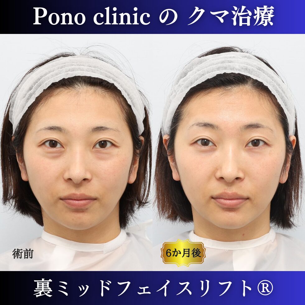 クマ取り東京、裏ミッドフェイスリフト、30代女性の症例