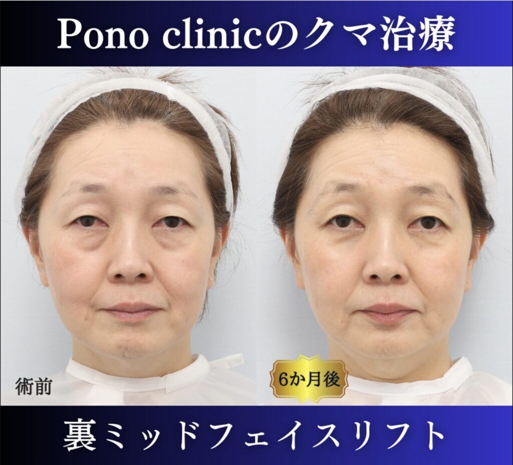 クマ取り東京、裏ミッドフェイスリフト、50代女性の症例 (1)