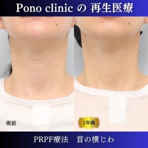 首のしわ、PRPF療法