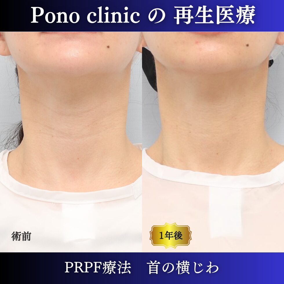 首のしわ、PRPF療法