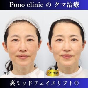 クマ取り東京、裏ミッドフェイスリフト、50代の症例