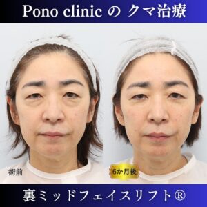 クマ取り東京、50代のクマ治療、裏ミッドフェイスリフト