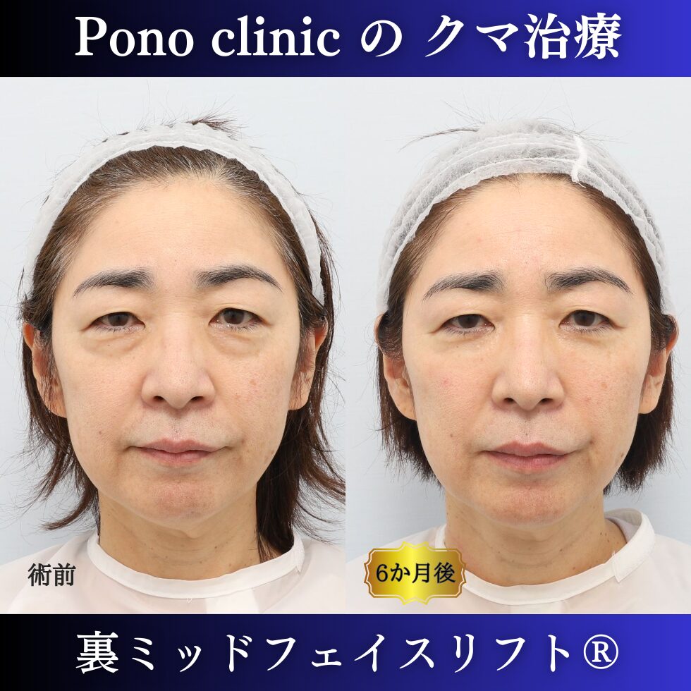 クマ取り東京、50代のクマ治療、裏ミッドフェイスリフト