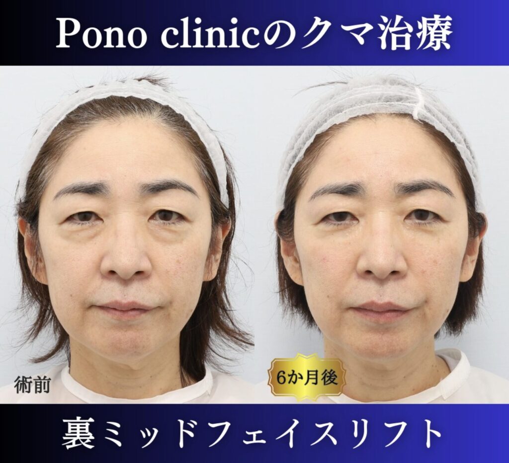 クマ取り東京、50代のクマ治療、裏ミッドフェイスリフト (1)