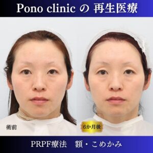 額、こめかみ、PRPF療法