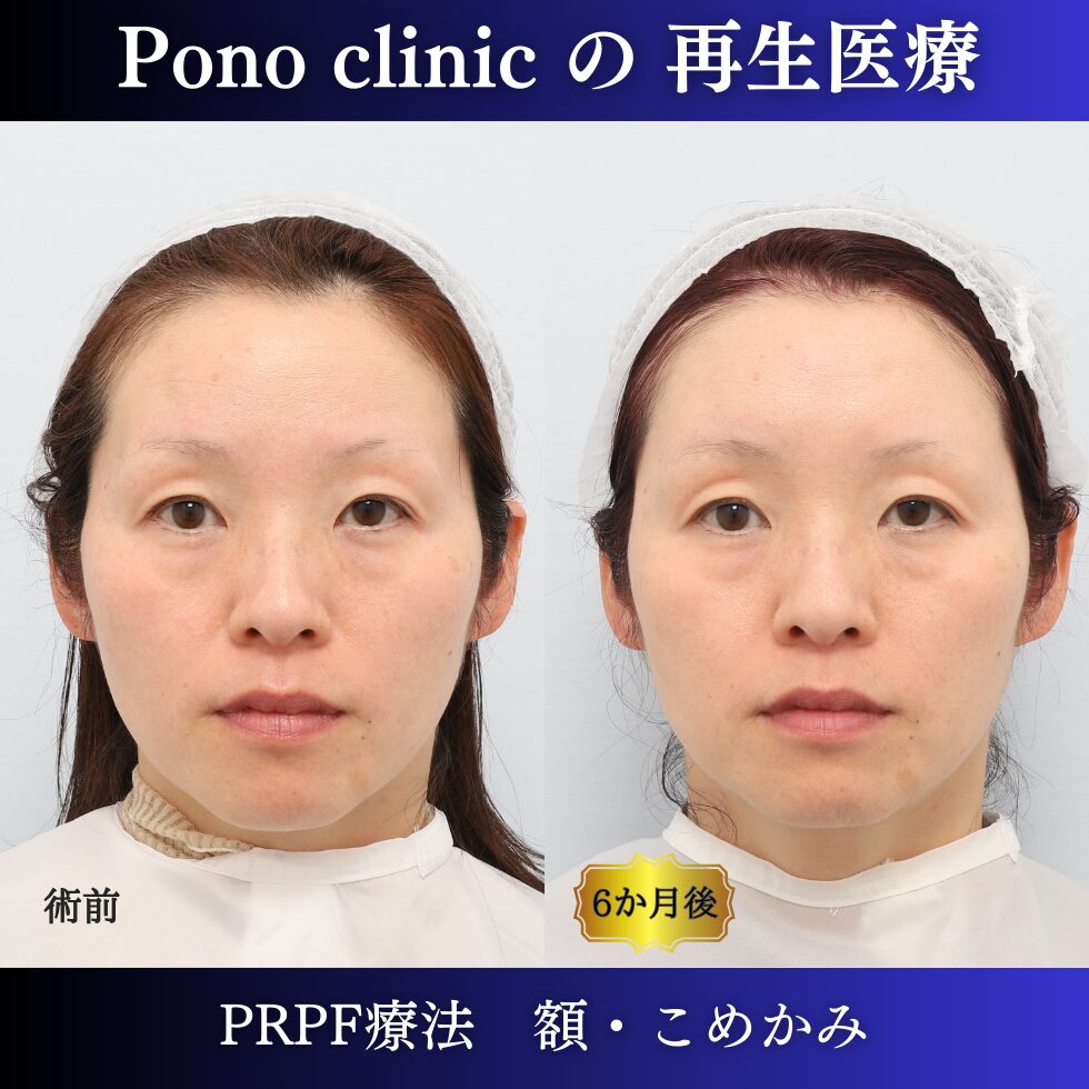 額、こめかみ、PRPF療法