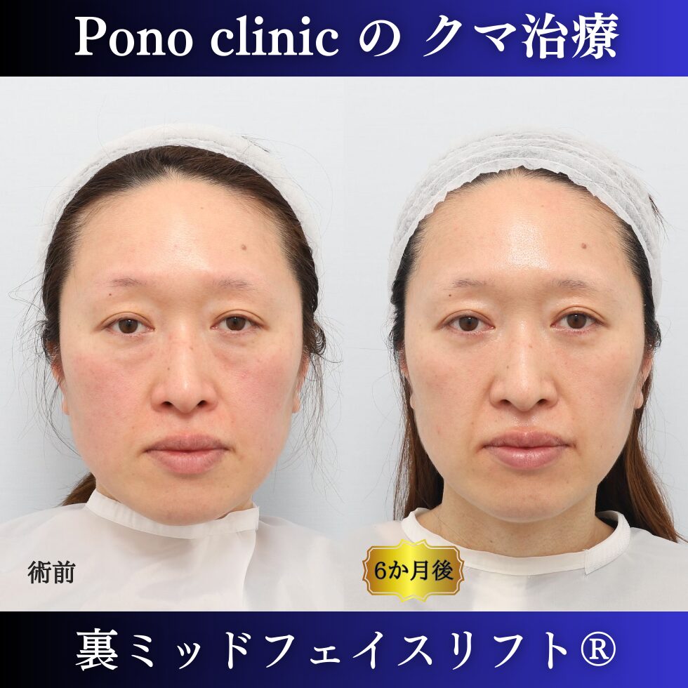 クマ取り東京、40代女性、クマ治療（裏ミッドフェイスリフト）