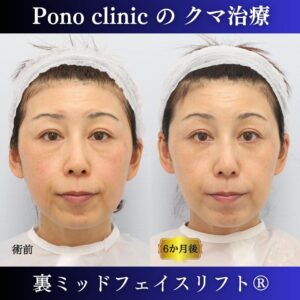 クマ取り東京、裏ミッドフェイスリフト（裏ハムラを含む）、他院修正、異物除去、40代のクマ治療