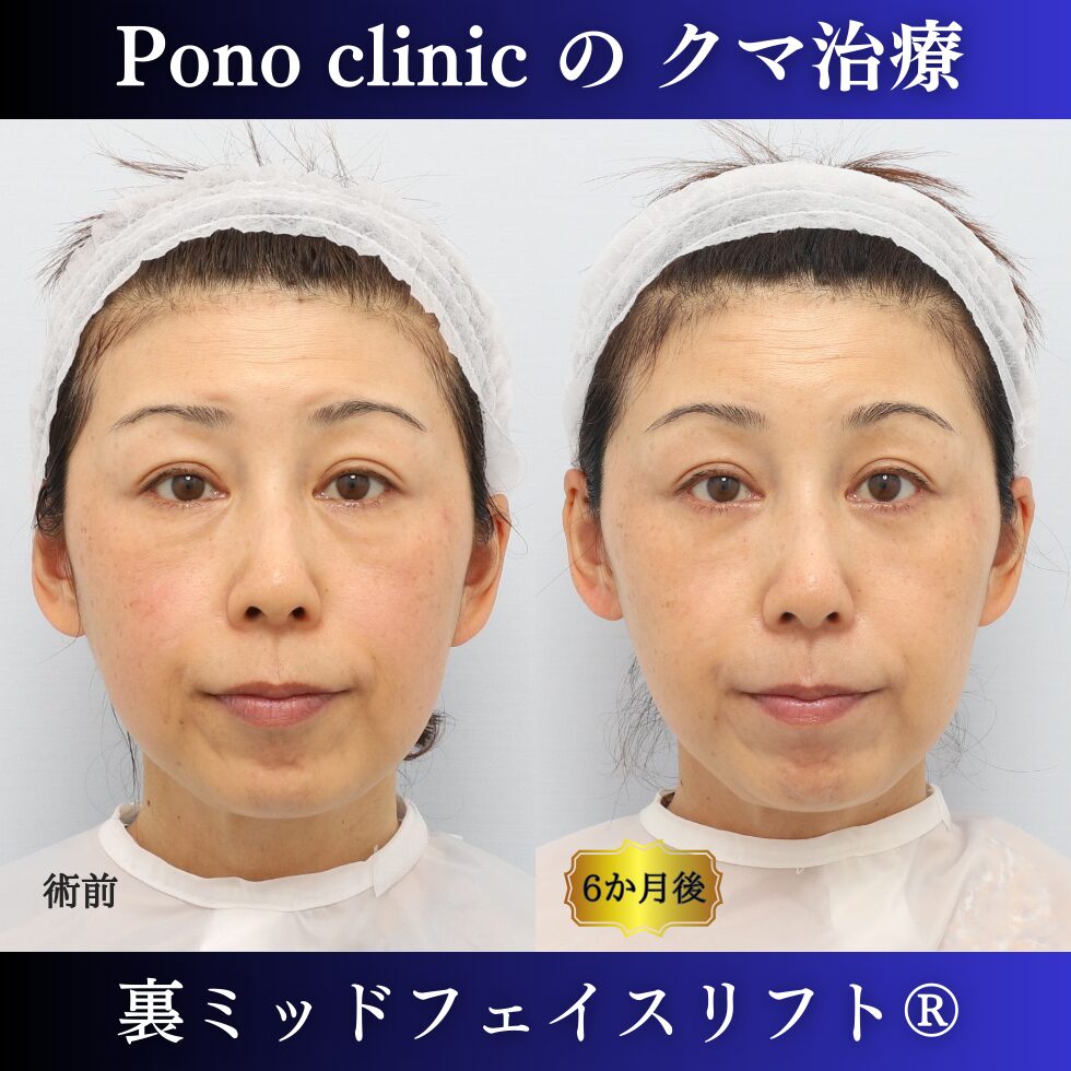 クマ取り東京、裏ミッドフェイスリフト（裏ハムラを含む）、他院修正、異物除去、40代のクマ治療