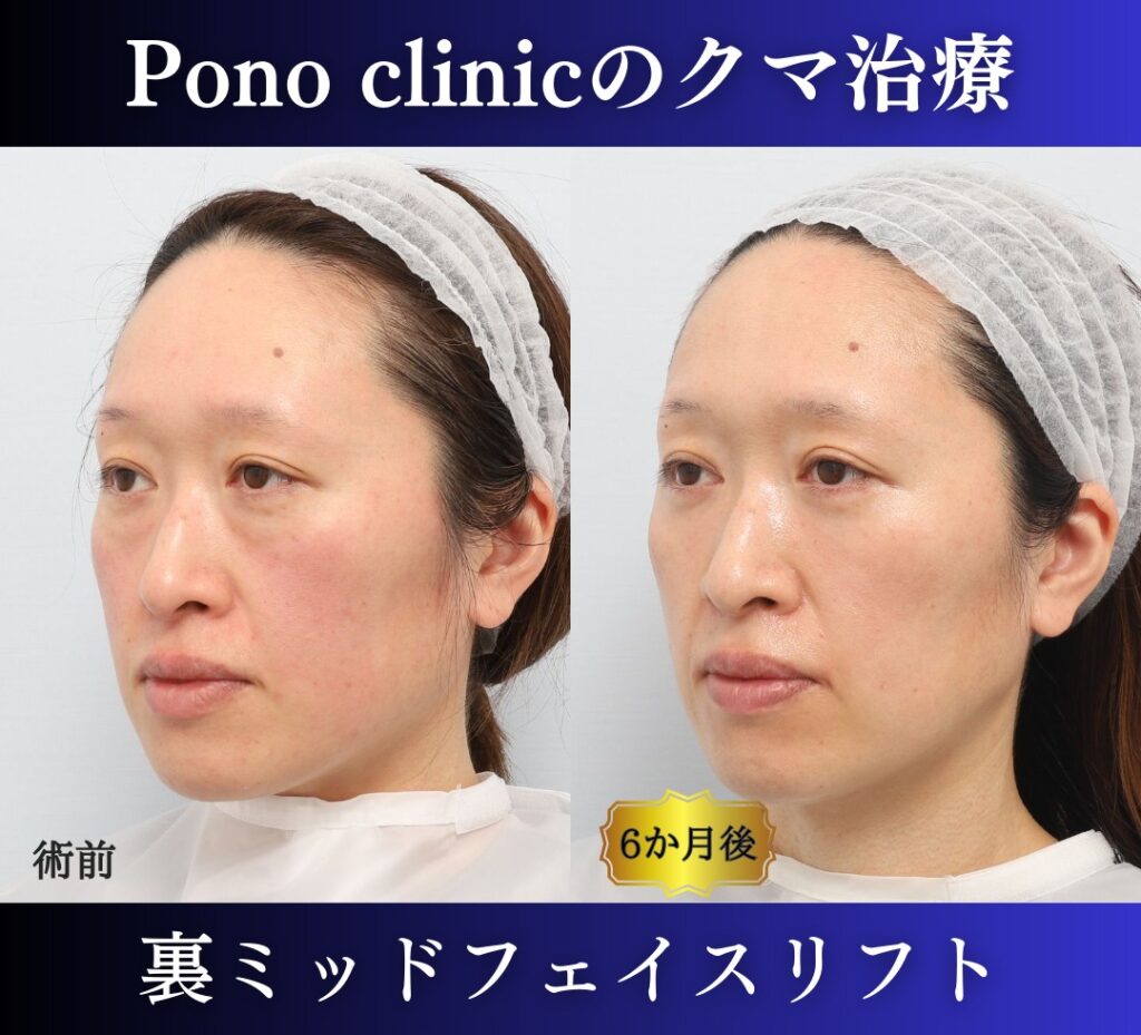 40代女性、クマ治療(裏ミッドフェイスリフト) (3)