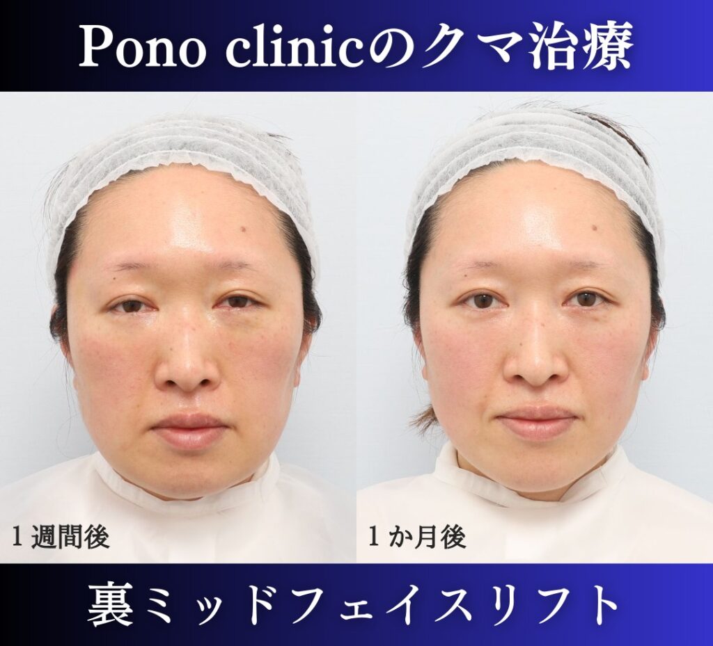 40代女性、クマ治療(裏ミッドフェイスリフト) (1)