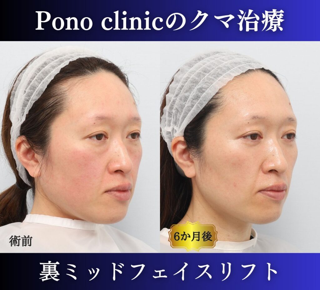 40代女性、クマ治療(裏ミッドフェイスリフト) (2)