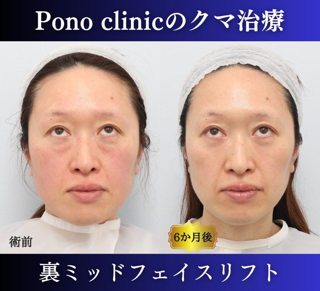 40代女性、クマ治療(裏ミッドフェイスリフト) (4)