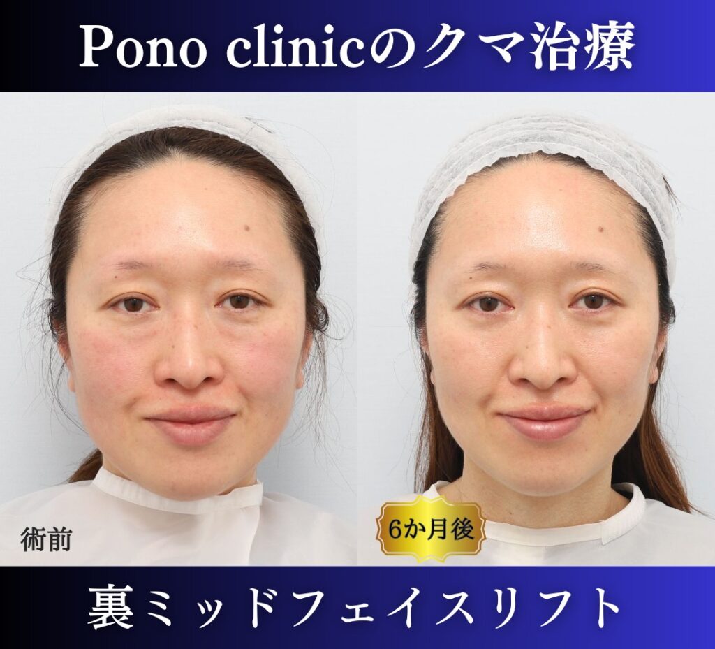 40代女性、クマ治療(裏ミッドフェイスリフト) (5)