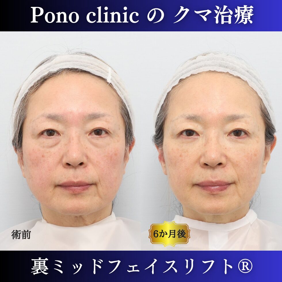 クマ取り東京、裏ミッドフェイスリフト（裏ハムラを含む）、60代女性の症例