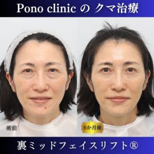 50代女性、クマ取り東京、裏ミッドフェイスリフト® の症例