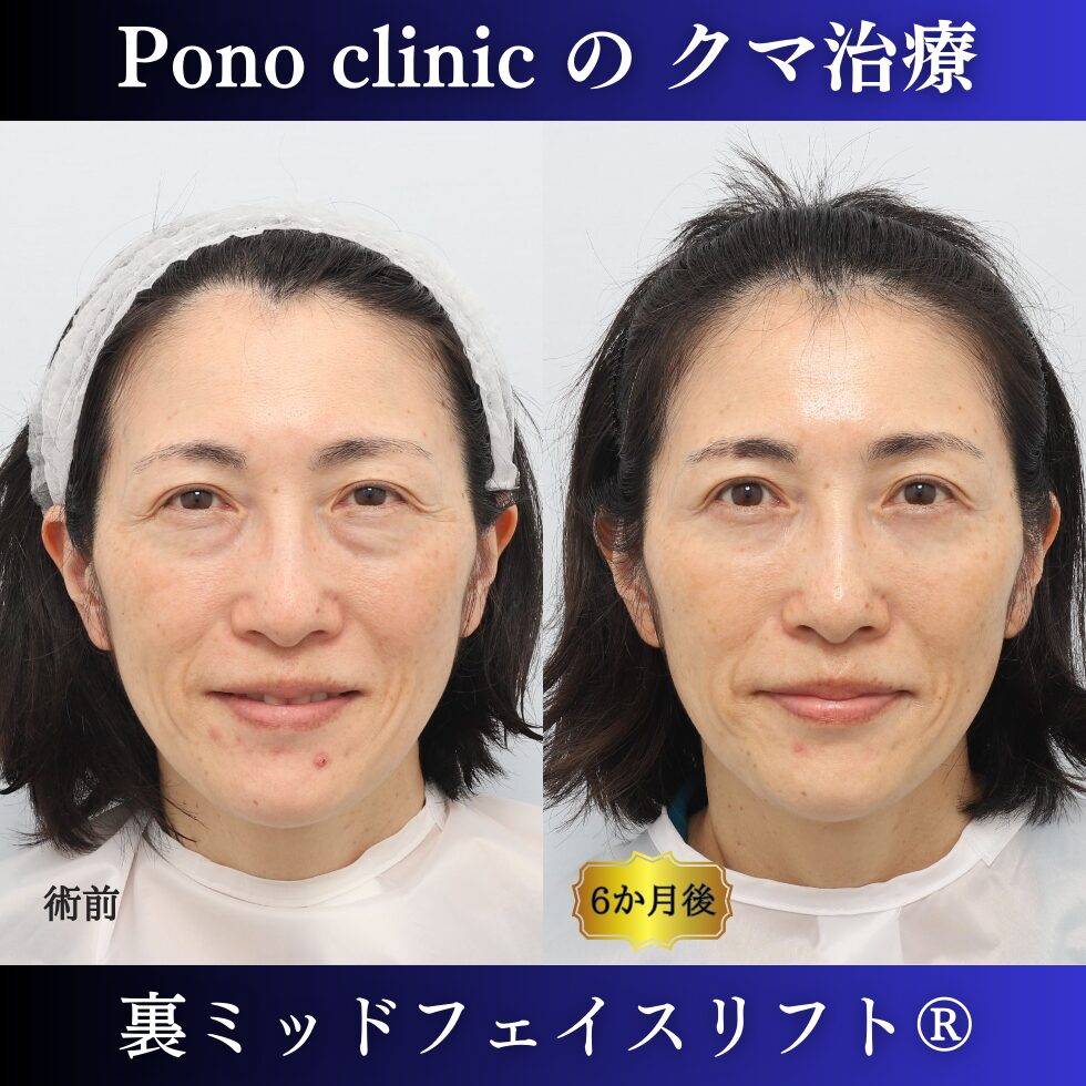 50代女性、クマ取り東京、裏ミッドフェイスリフト® の症例