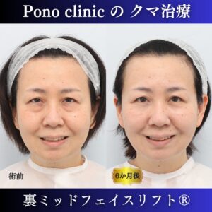 50代のクマ治療、クマ取り東京、裏ミッドフェイスリフト®、女性の症例