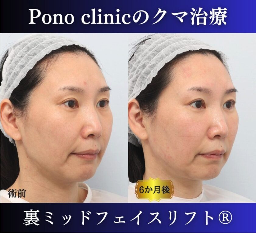 クマ取り東京、裏ミッドフェイスリフト®、グラマラスライン形成、目尻切開の症例、40代女性 (2)