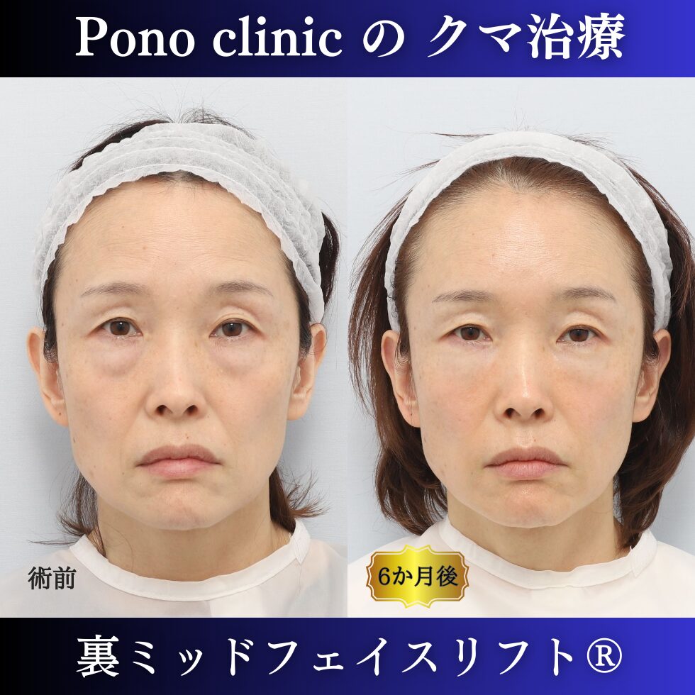 目の下のクマ治し方、40代の若返り美容、クマ取り東京、裏ミッドフェイスリフト、PRPF療法の症例