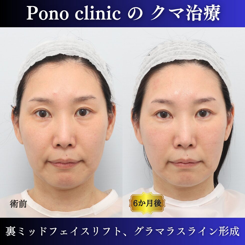 クマ取り東京、裏ミッドフェイスリフト®、グラマラスライン形成、目尻切開の症例、40代女性