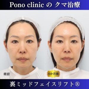クマ取り東京、裏ミッドフェイスリフト®、40代の症例