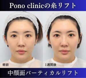 糸リフト、中顔面バーティカルリフトの症例、30代女性 (3)