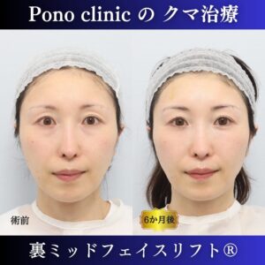 目の下のクマ治し方、クマ取り東京、裏ミッドフェイスリフト®+目の上PRPF®療法の症例、40代女性