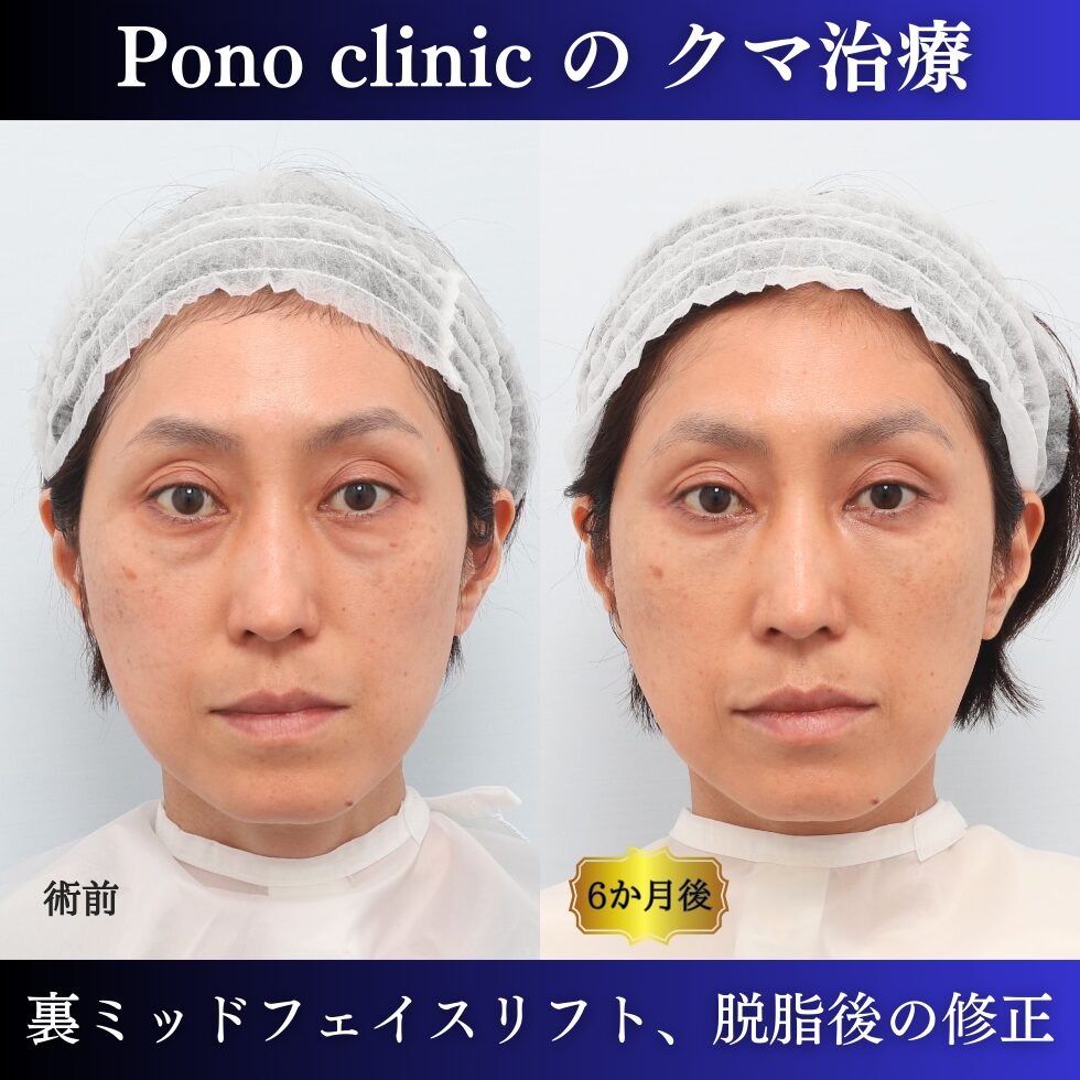 クマ取り東京、目の下のクマ治し方、裏ハムラ+ミッドフェイスリフト、他院修正の症例