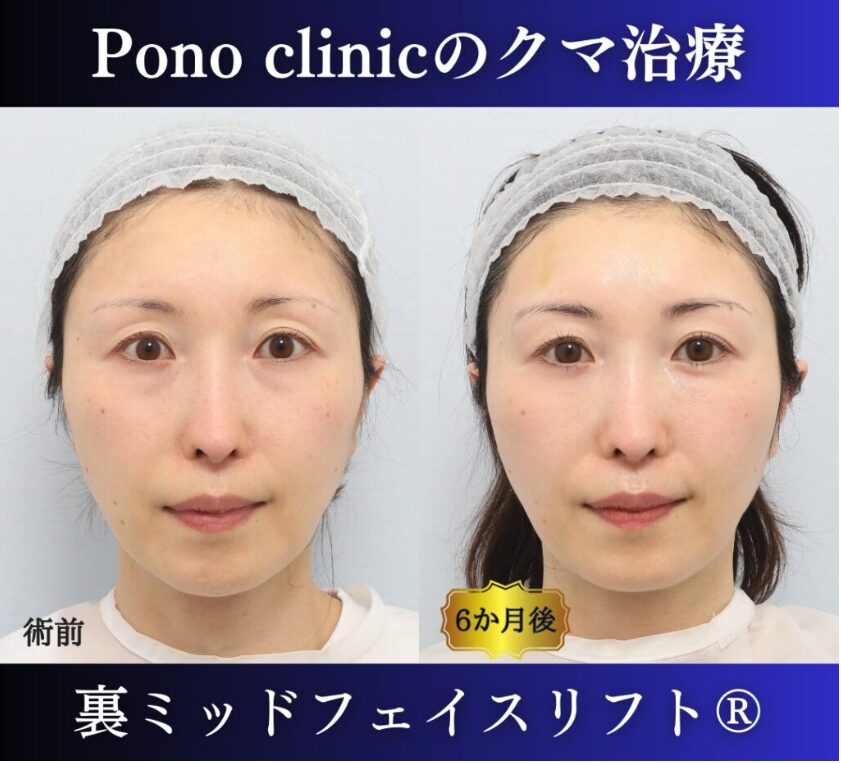 目の下のクマ治し方、クマ取り東京、裏ミッドフェイスリフト®+目の上PRPF®療法の症例、40代女性 (7)