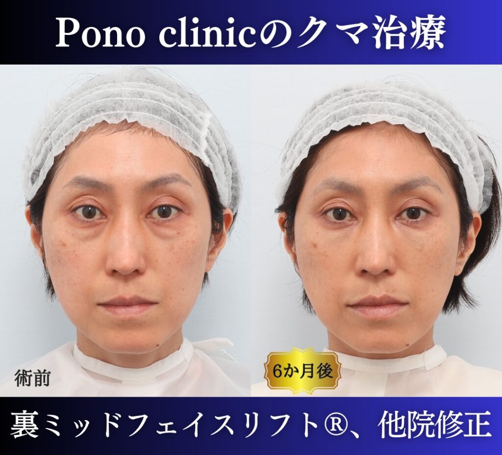 40代女性 裏ミッドフェイスリフト 正面の比較画像