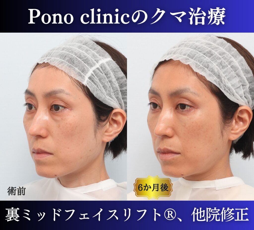 40代女性 裏ミッドフェイスリフト 左斜位の比較画像