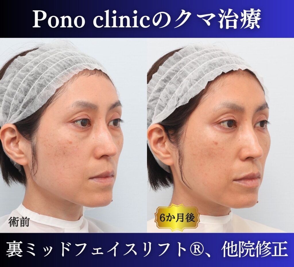 40代女性 裏ミッドフェイスリフト 右斜位の比較画像
