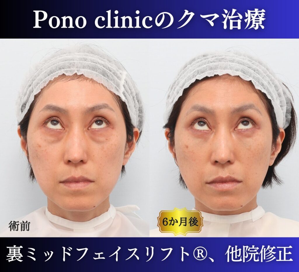 40代女性 裏ミッドフェイスリフト 上方視の比較画像