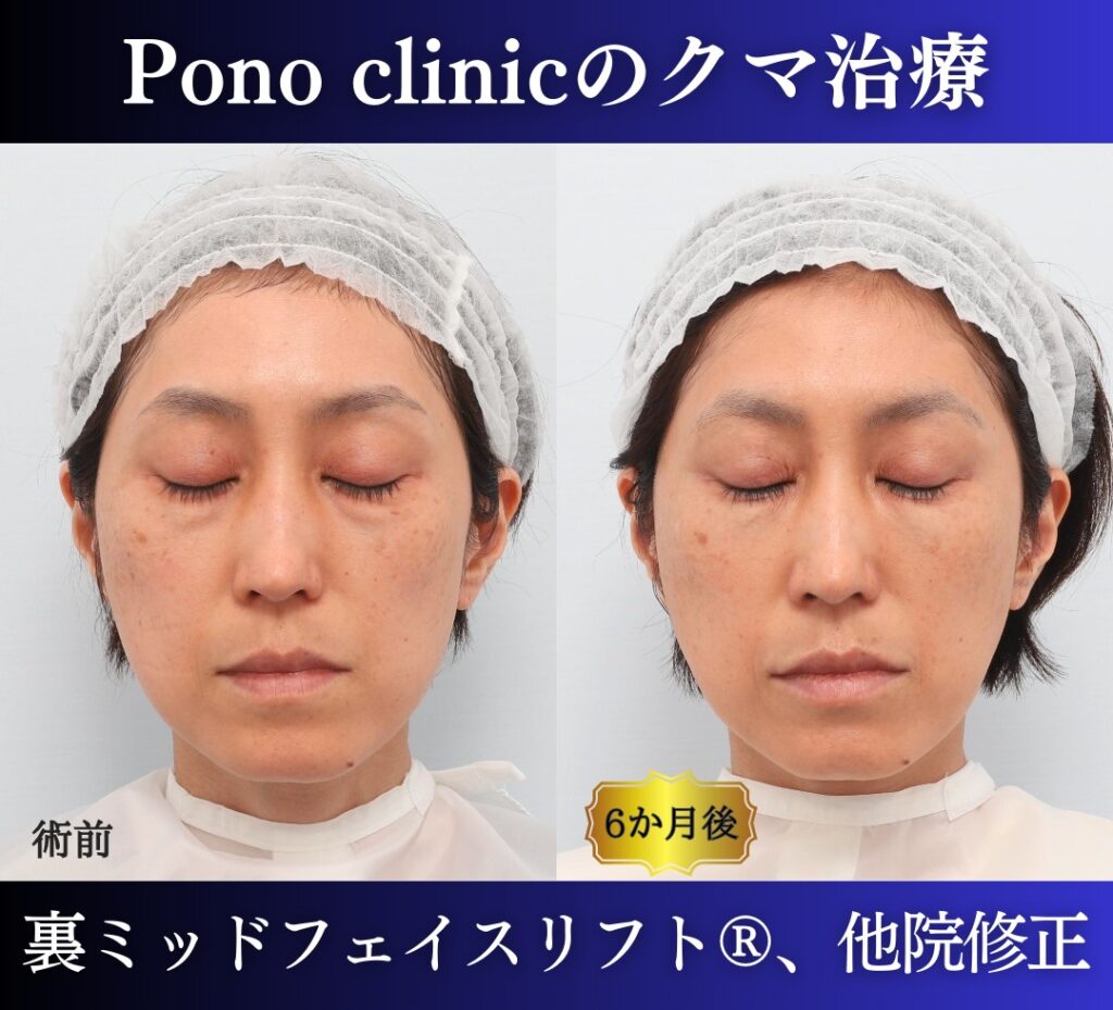 40代女性 裏ミッドフェイスリフト 閉眼時の比較画像
