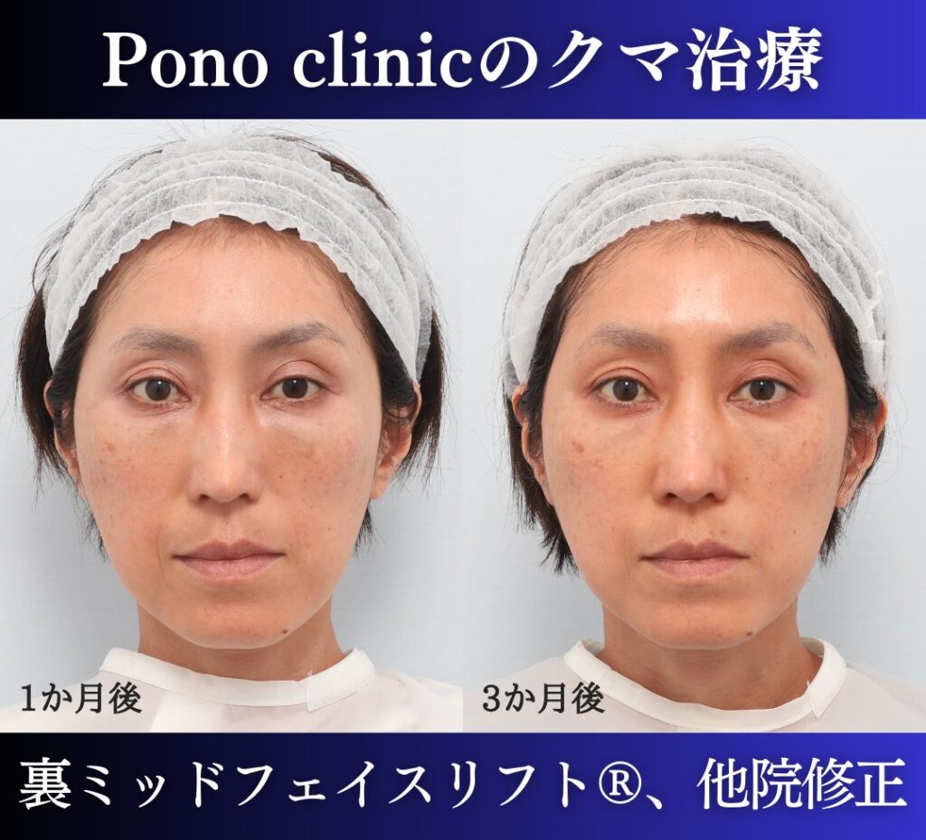 40代女性 裏ミッドフェイスリフト 術後1か月と3か月の経過