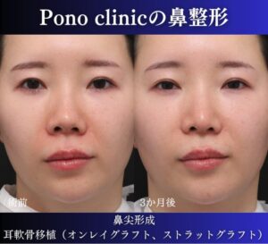 鼻尖形成、軟骨移植の症例 (4)