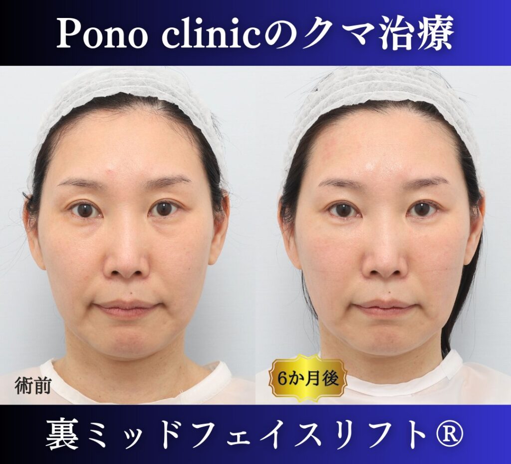 クマ取り東京、裏ミッドフェイスリフト®、グラマラスライン形成、目尻切開の症例、40代女性