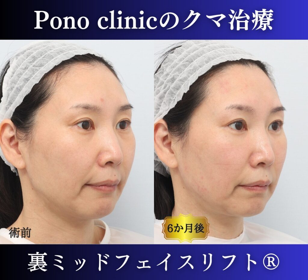 クマ取り東京、裏ミッドフェイスリフト®、グラマラスライン形成、目尻切開の症例、40代女性 (2)