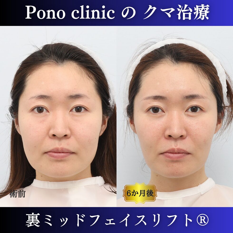 クマ取り東京、目の下のクマ治し方、裏ミッドフェイスリフト、30代女性の症例