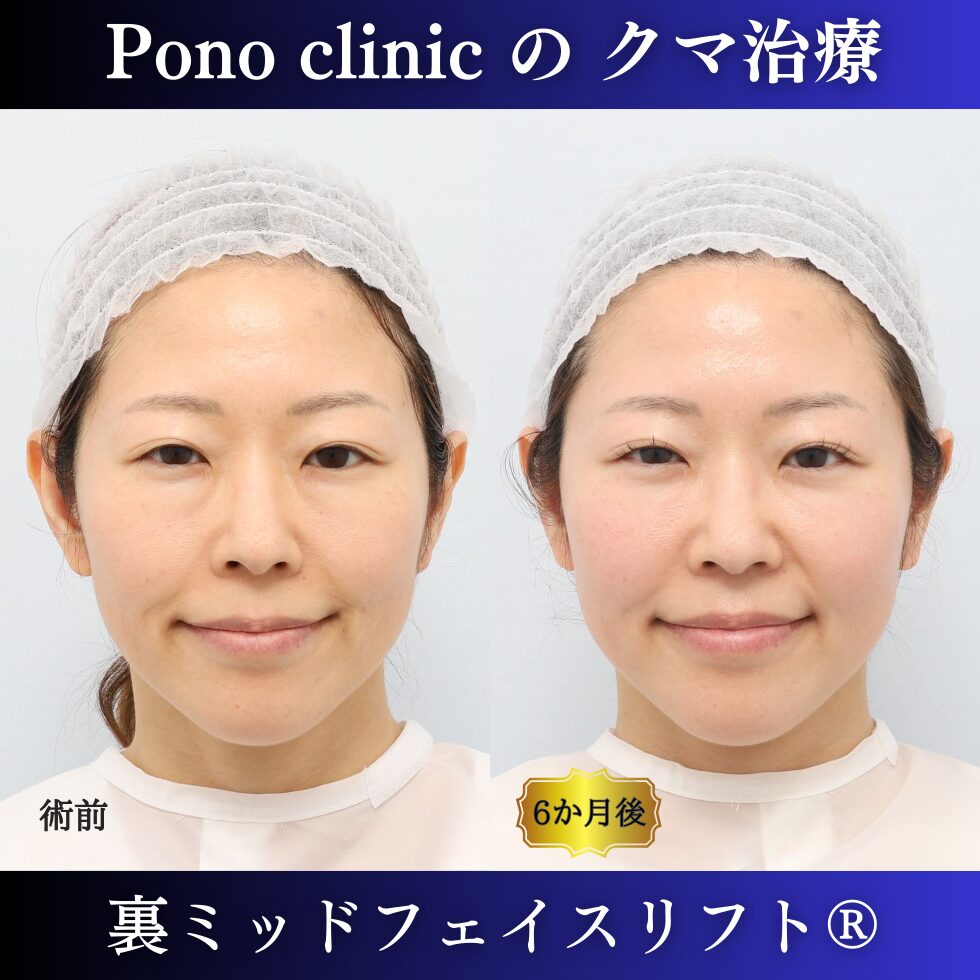 40代女性、目の下のクマ取り東京、裏ミッドフェイスリフト® の症例