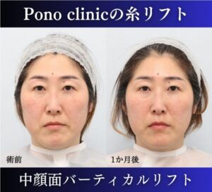 中顔面バーティカルリフト、40代糸リフトの症例 (3)