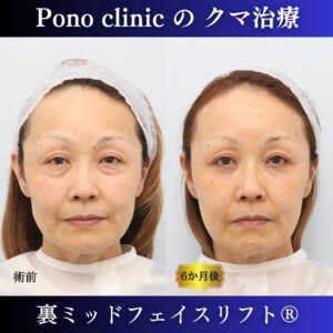 50代女性、目の下のたるみ取りの治療、裏ミッドフェイスリフト