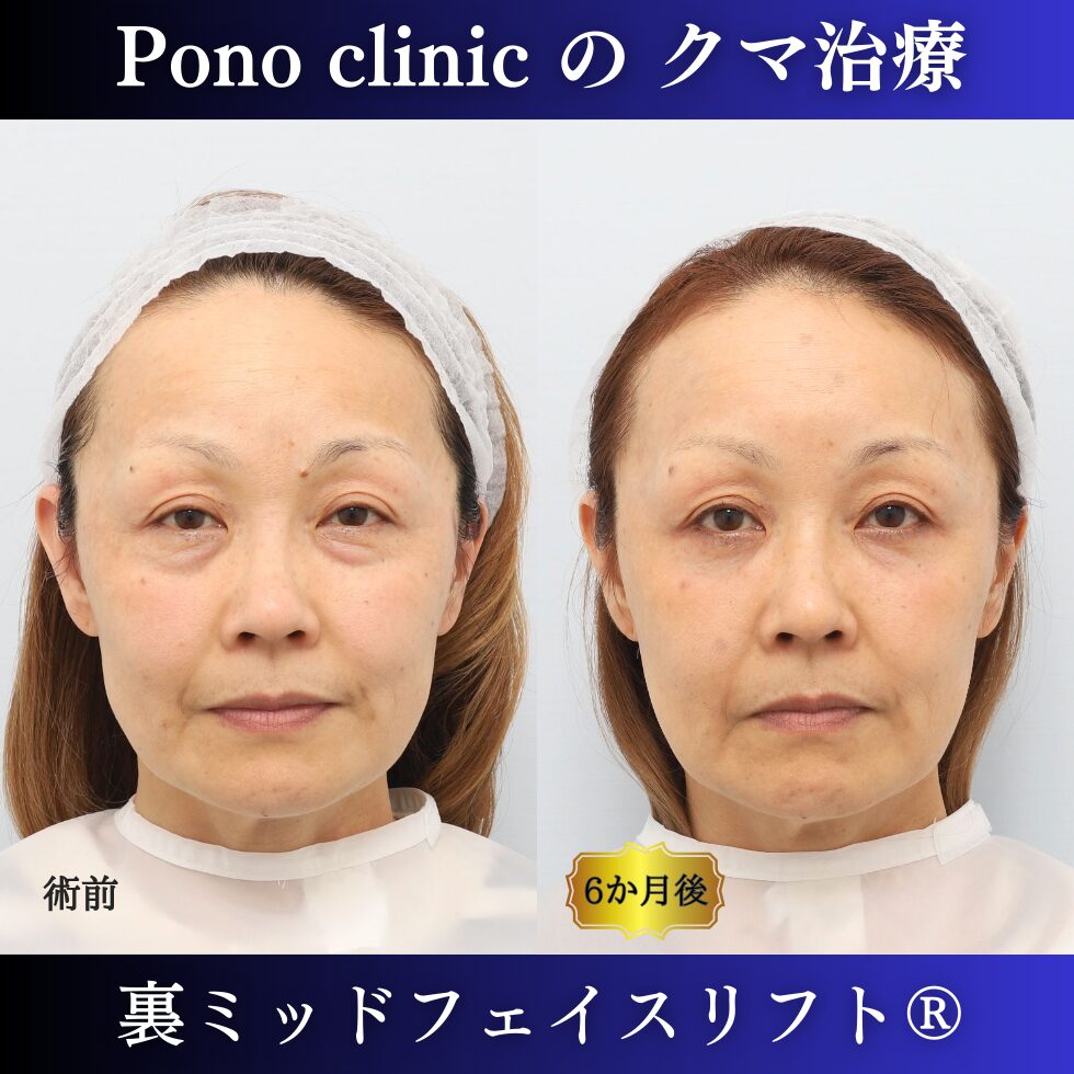 50代女性、目の下のたるみ取りの治療、裏ミッドフェイスリフト