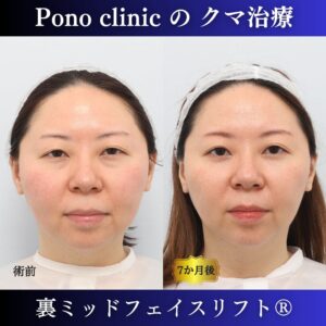 30代、目の下のクマ取り、裏ミッドフェイスリフト®